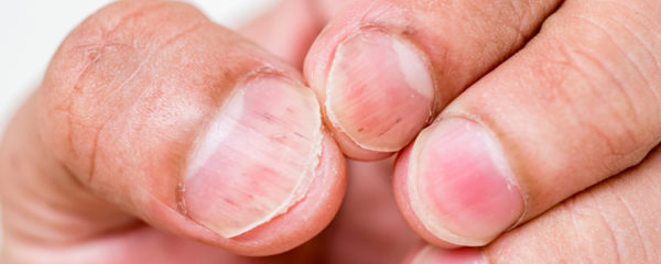 psoriasis